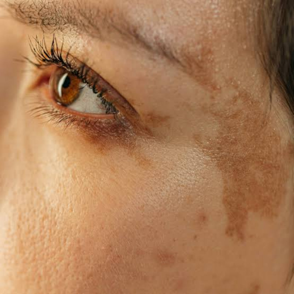 Pigmentation