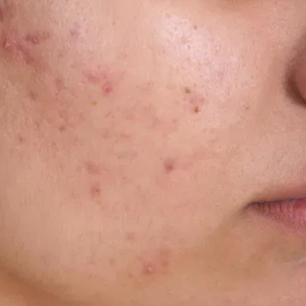 Blemishes