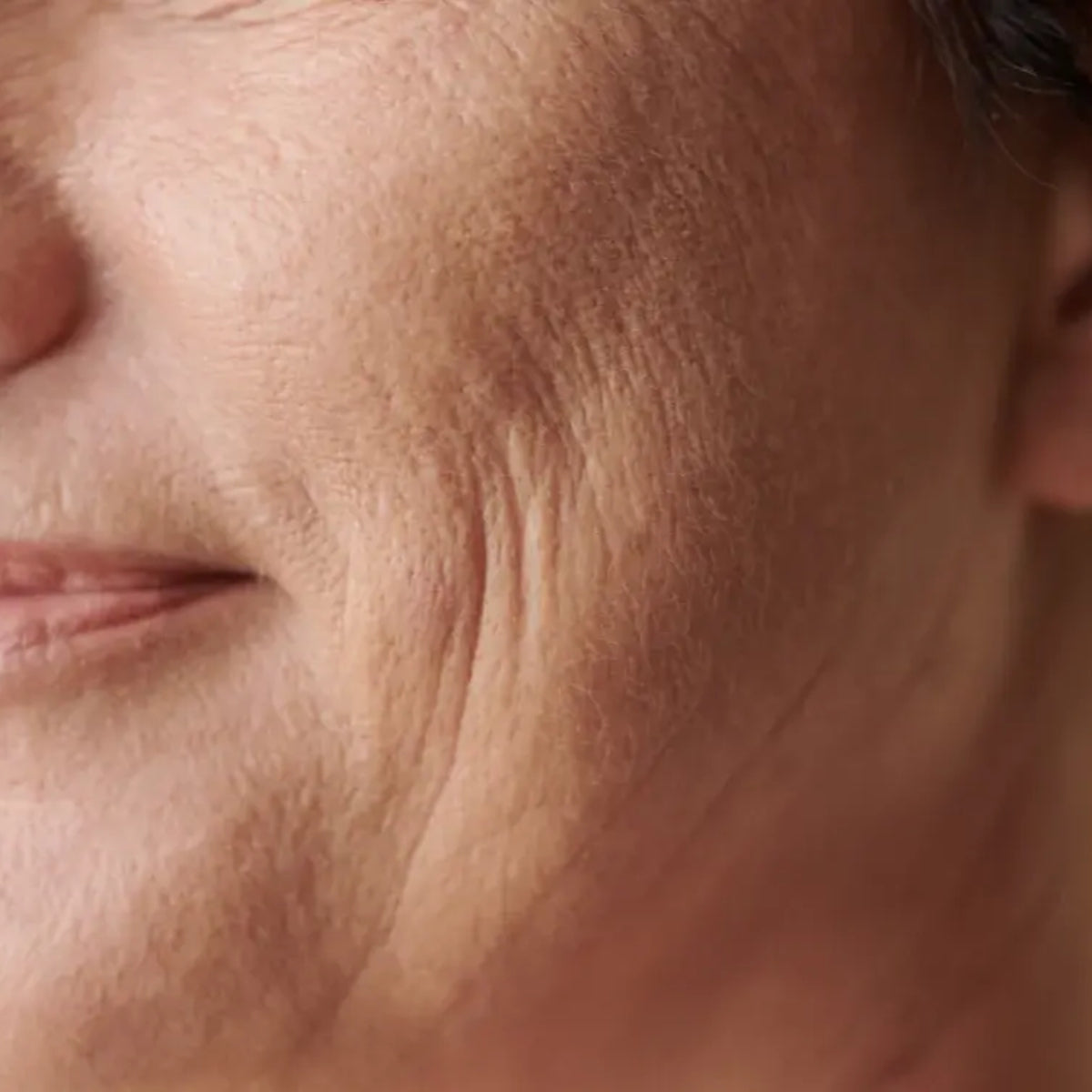 Fine Lines & Wrinkles
