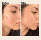 Acne Treatment Bundle | Glycolic Acid 7% Toner + Acne Control Cleanser + Niacinamide Serum
