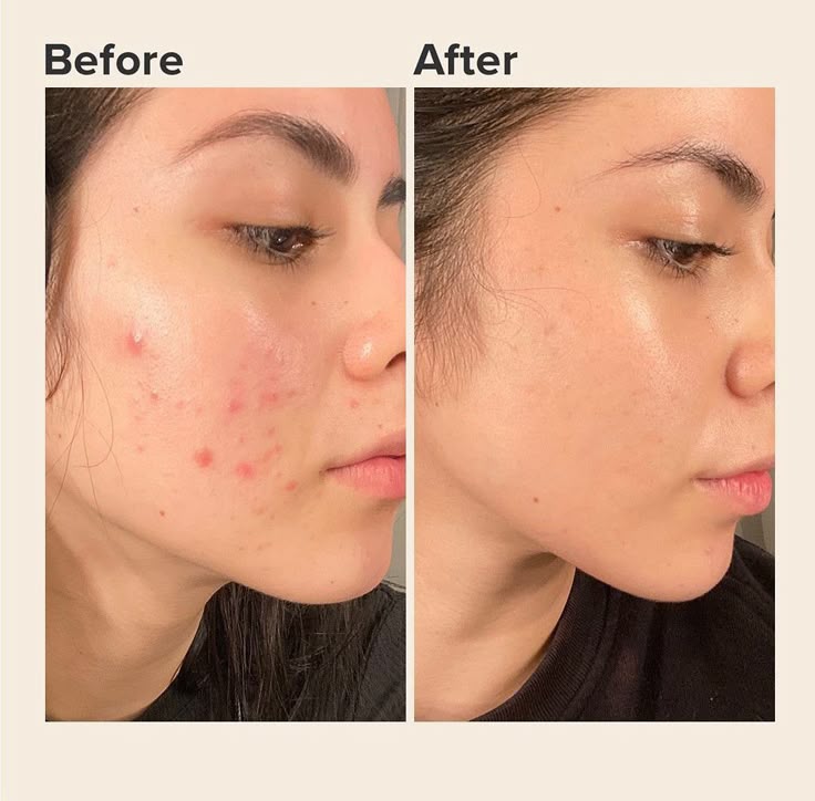 Acne Clear Bundle