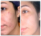 Acne Treatment Bundle | Glycolic Acid 7% Toner + Acne Control Cleanser + Niacinamide Serum