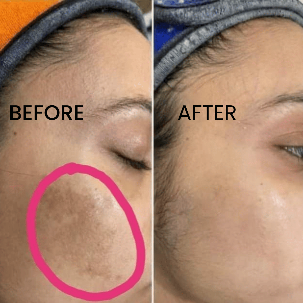 Before and after results using Dermasation Glycolic Acid Toner for dark spots and skin texture
