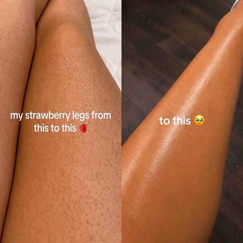 Before and after using Dermasation Glycolic Acid Toner on strawberry legs and keratosis pilaris