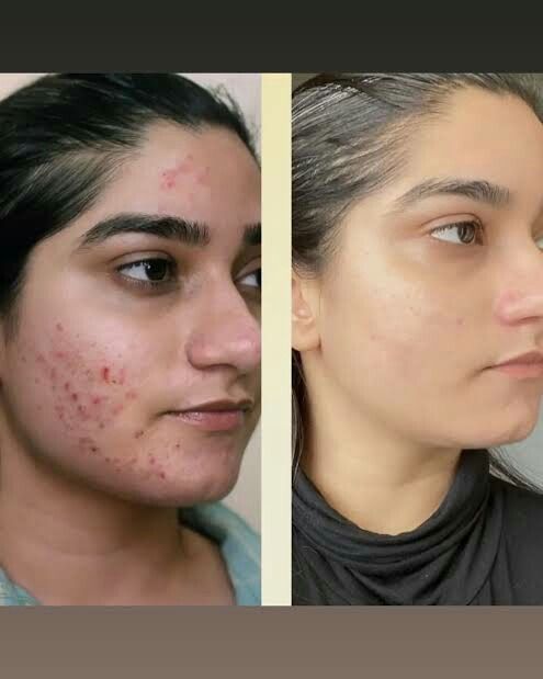 Acne Treatment Bundle | Glycolic Acid 7% Toner + Acne Control Cleanser + Niacinamide Serum