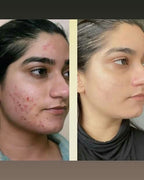 Acne Treatment Bundle | Glycolic Acid 7% Toner + Acne Control Cleanser + Niacinamide Serum